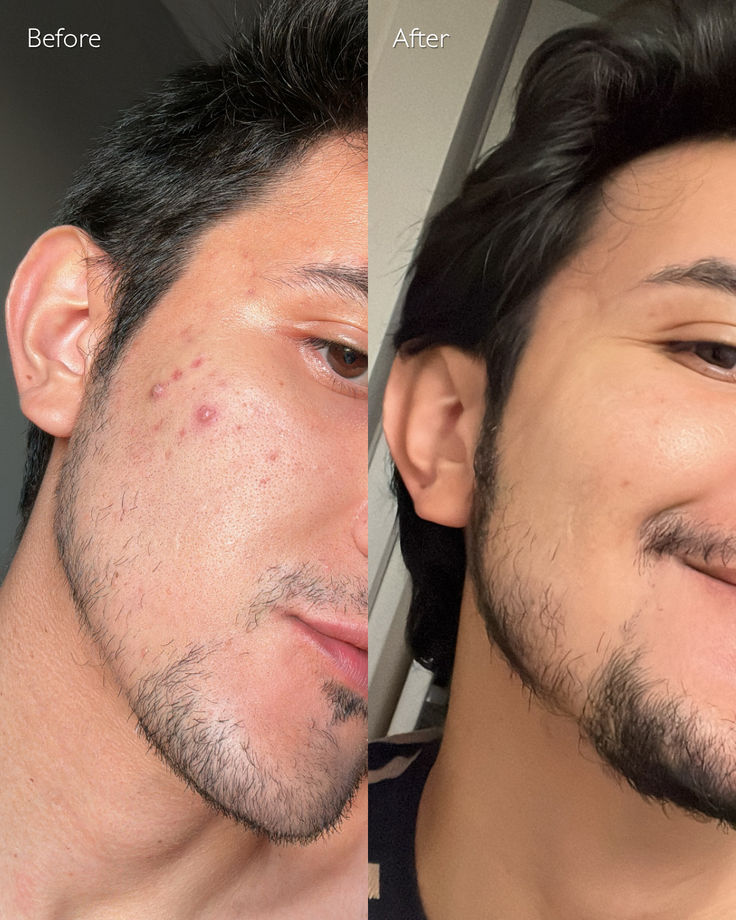 COSRX Acne Pimple Master Patch [1 Sheet]